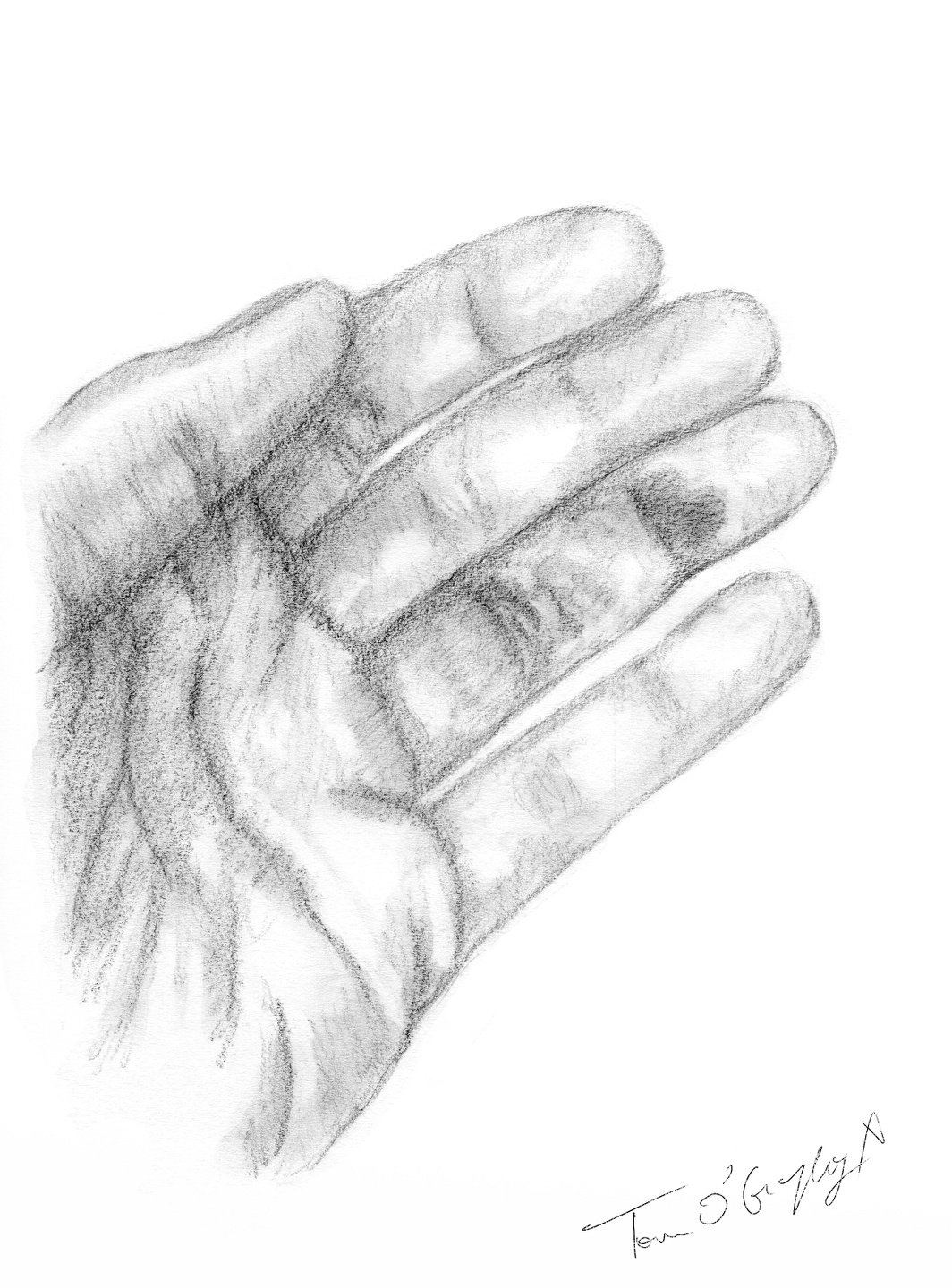 Fracture de la deuxième phalange des doigts | thoracotomie