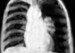 pneumothorax complet