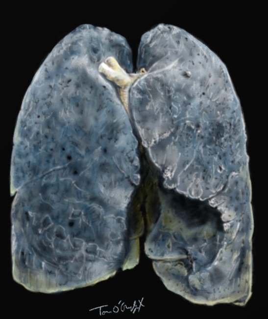 poumon fumeur exacerbation BPCO emphyseme