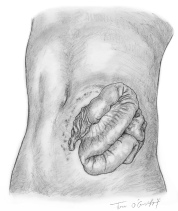Plaie abdomen evisceration