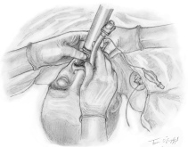 intubation orotracheale laryngoscopie sonde
