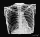 pneumothorax radiographie