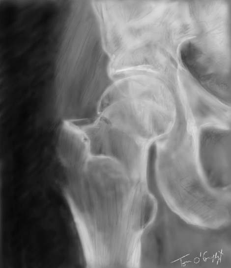 fracture col femur radiographie