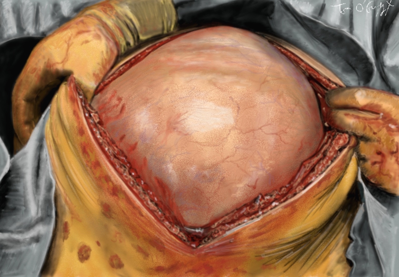 Kyste ovarien : hémorragie, rupture et compression | thoracotomie