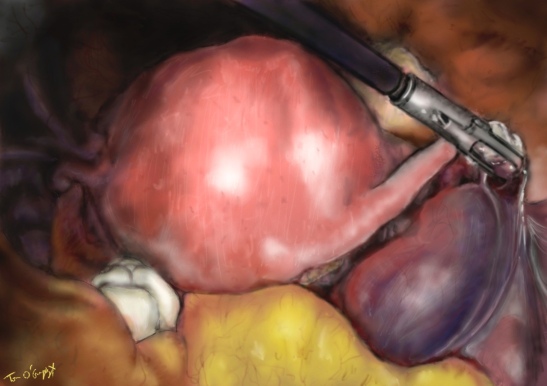 grossesse extra uterine tubaire