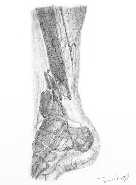 lésions vasculaire de l'artère tibiale postérieure sur une fracture diaphysaire tibiale déplacée, artériographie en négatif