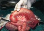 occlusion intestin grele obstruction ascaris