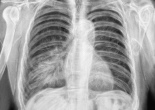 pneumonie infectieuse pneumopathie franche lobaire aigue