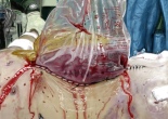 bogota bag damage control laparotomy