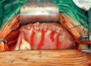 cesarienne suture uterine