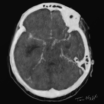 hemorragie meningee scanner cerebral